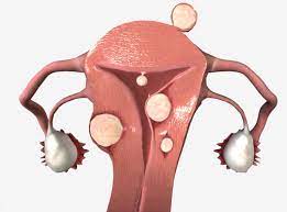 leiomiomas uterinos