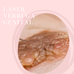 verrugas genitales en hombres